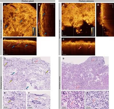 Diagnosis of Pituitary Adenoma Biopsies by Ultrahigh Resolution Optical Coherence Tomography Using Neuronal Networks